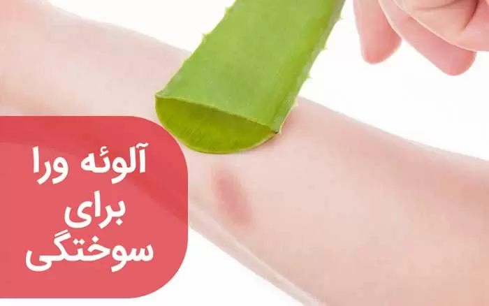 ژل آلوئه ورا برای سوختگی: معجزه ای گیاهی!